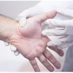 Trigger finger treatment