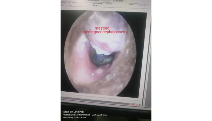 Is Earwax Removal Necessary? Experts Weigh In